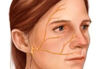 facial paralysis ramsay hunt syndrome