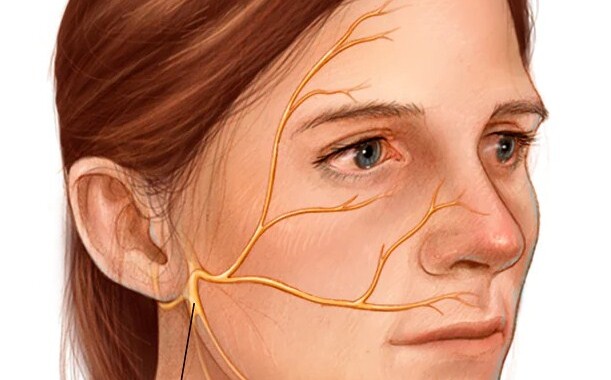 facial paralysis ramsay hunt syndrome